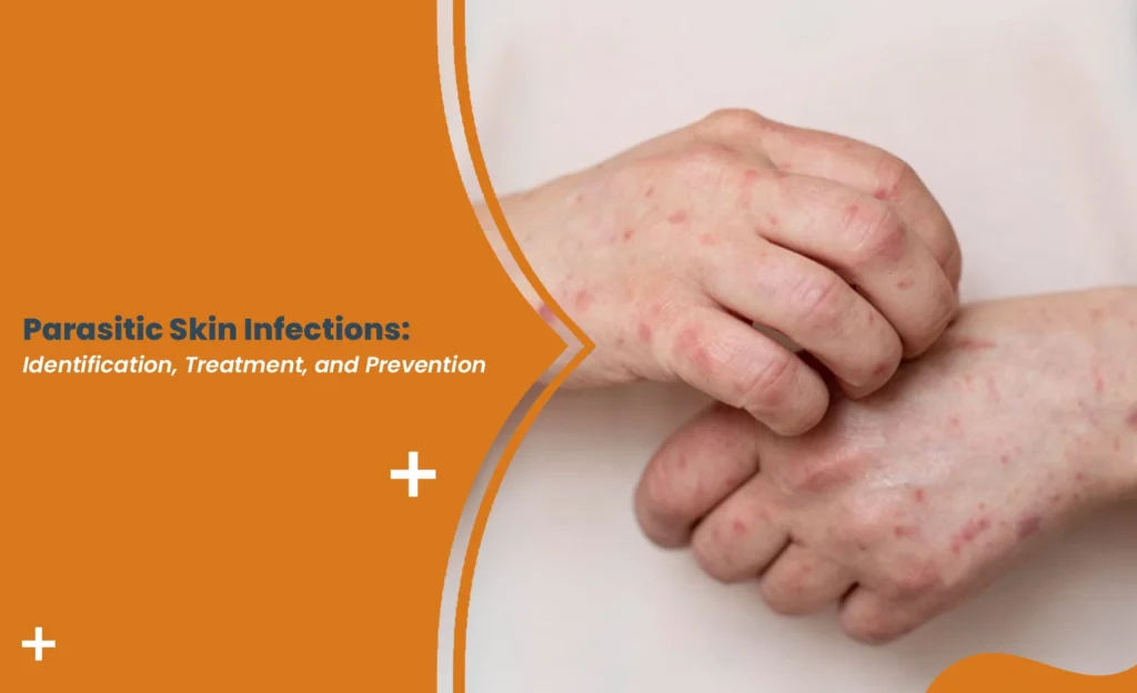 Hands with red rash caused by parasitic skin infection