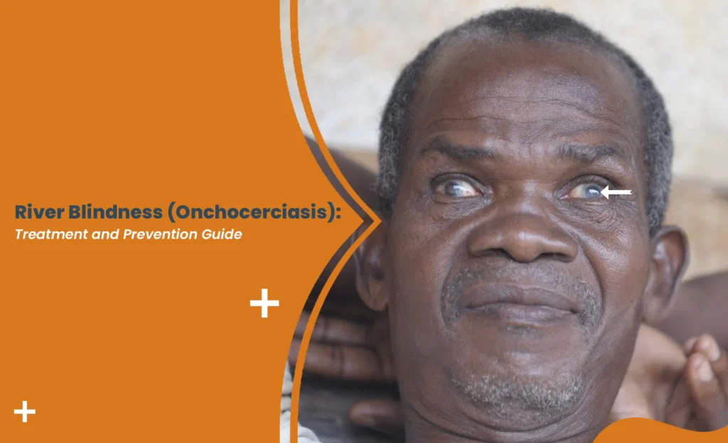 River blindness (onchocerciasis) affecting eyes and vision