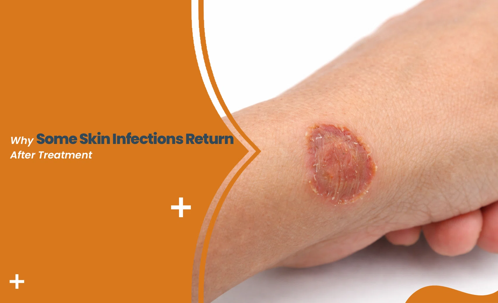 Recurring skin infections shown as a red circular rash on hand after treatment