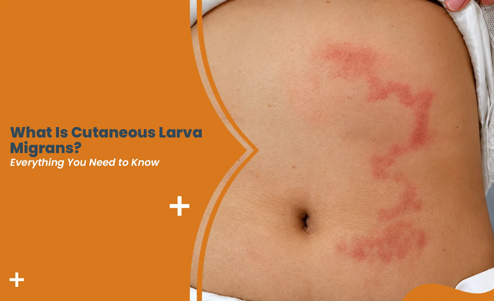 Cutaneous Larva Migrans rash on the skin
