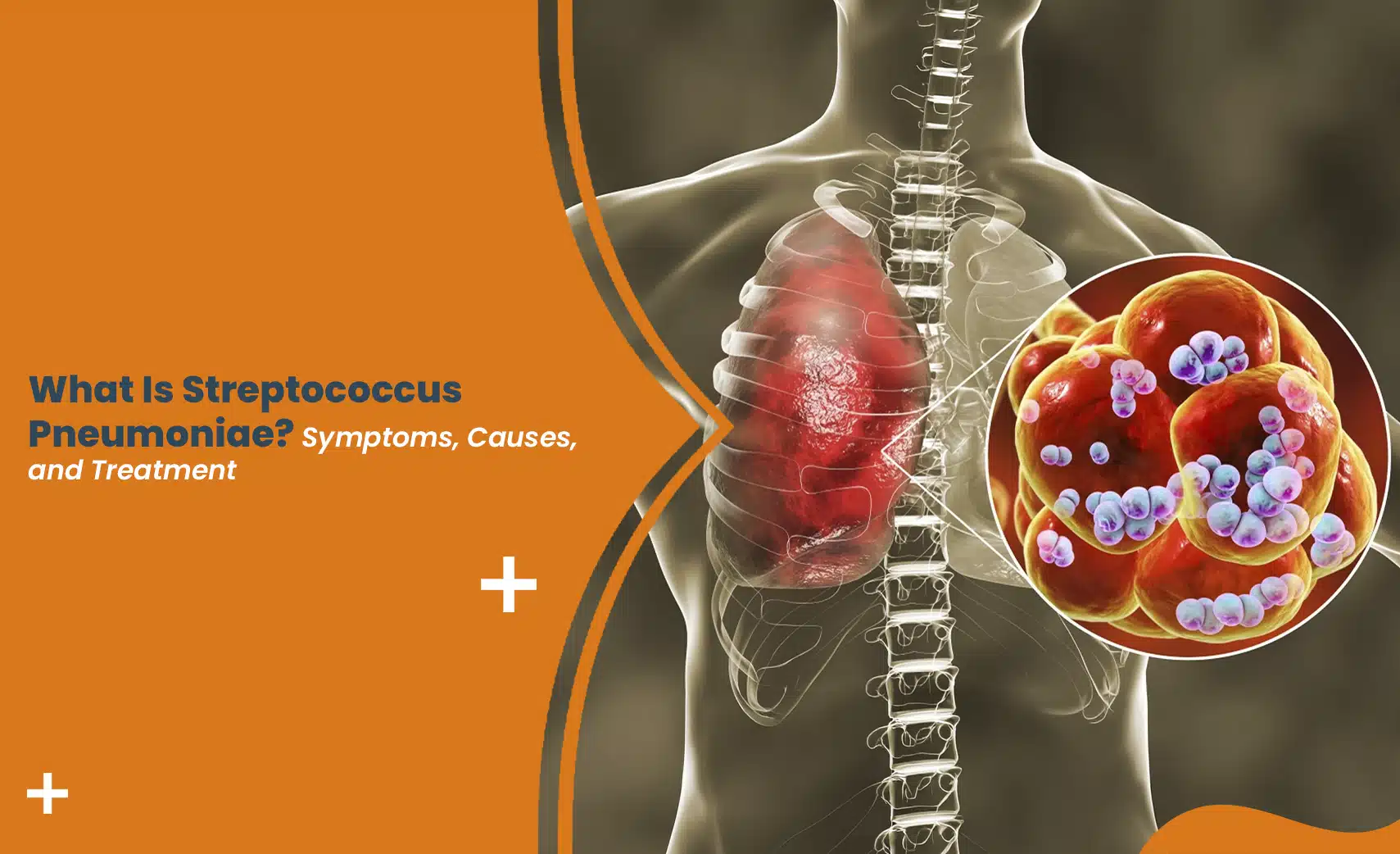 Illustration showing streptococcus pneumoniae symptoms and treatment, with an infected lung and magnified bacteria cells