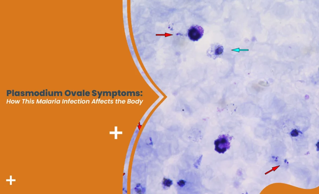 Blood smear microscopy image illustrating Plasmodium ovale symptoms and infected red blood cells under magnification