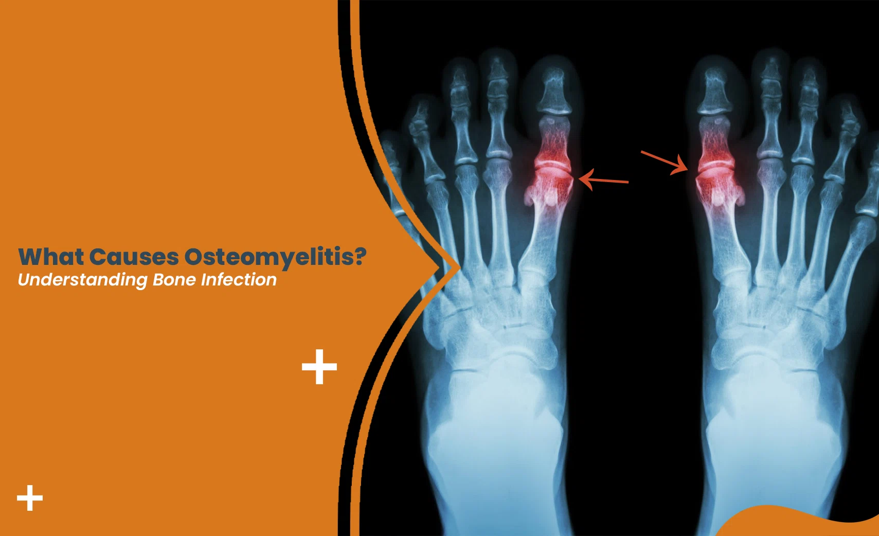 Osteomyelitis causes shown in foot X-ray with affected bone areas