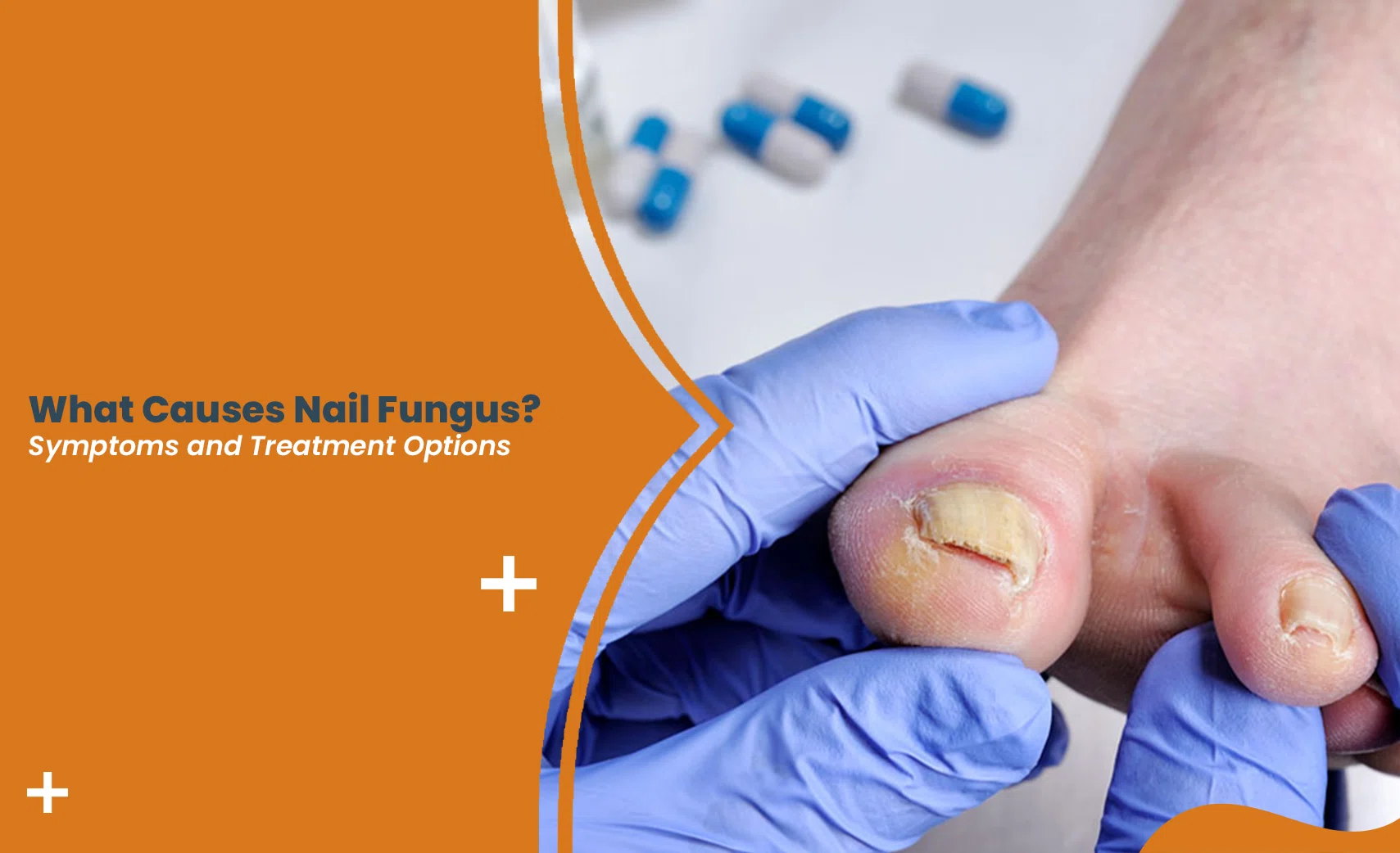 Nail fungus affecting thickened and discolored toenails during a medical examination